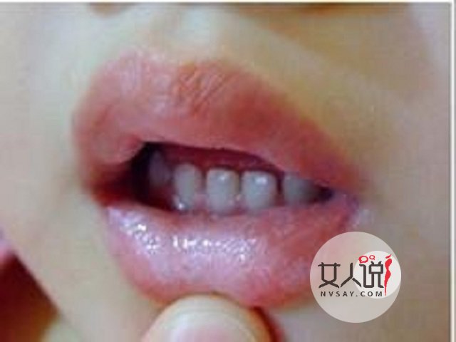 鹅口疮图片告诉你答案,千万别小看,有时甚至危及生命!!!