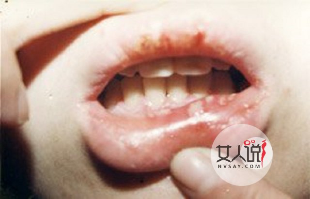 鹅口疮图片告诉你答案,千万别小看,有时甚至危及生命!!!