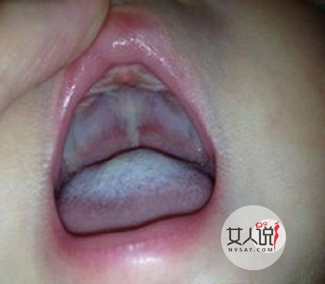 鹅口疮图片告诉你答案,千万别小看,有时甚至危及生命!!!