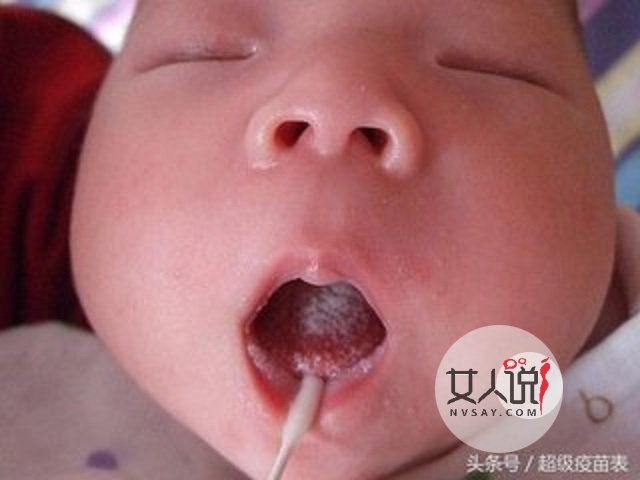 鹅口疮图片告诉你答案,千万别小看,有时甚至危及生命!!!