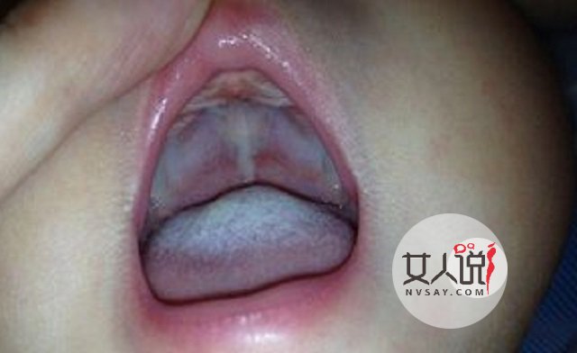 鹅口疮图片告诉你答案,千万别小看,有时甚至危及生命!!!