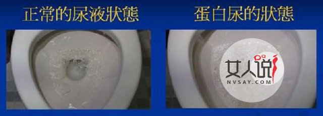 小便有泡沫?竟是你的身体可能出了哪些问题?不能忽视!!!