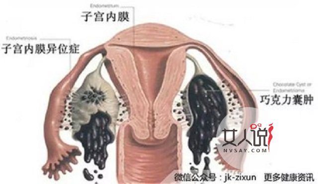 巧克力囊肿,那些你不能不知道的小知识,有可能救你哦