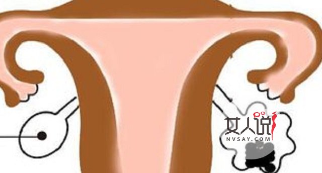 巧克力囊肿,那些你不能不知道的小知识,有可能救你哦