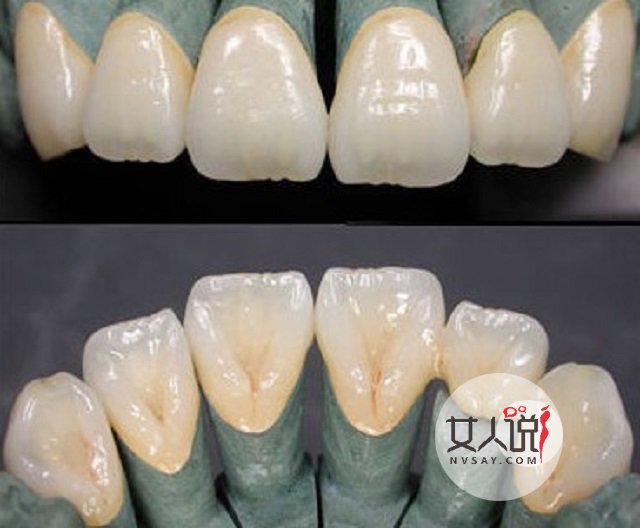 烤瓷牙价格表详细介绍,一口好牙笑出精彩人生!
