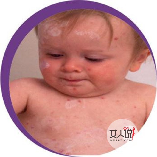 水痘图片好吓人!如何治疗好关键!