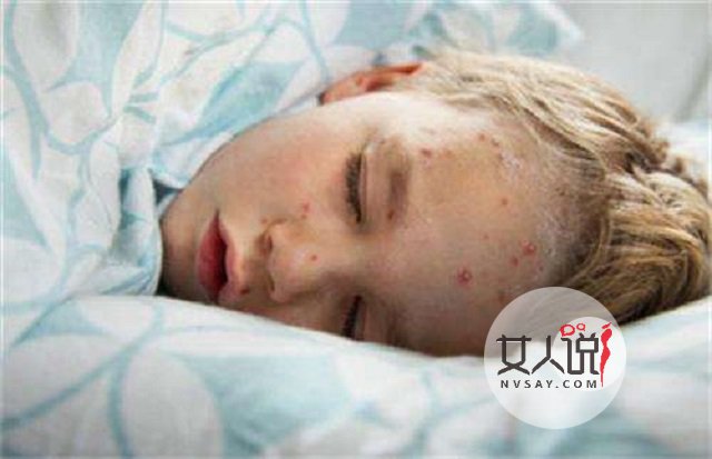 水痘图片好吓人!如何治疗好关键!
