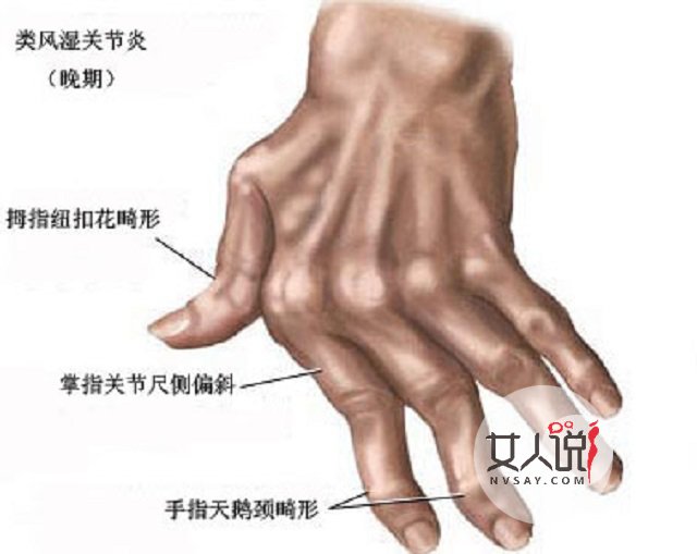 风湿病的症状,腿脚疼痛的同学“对号入座”啰!