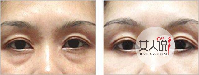 去眼袋价格不一?安全性更重要!