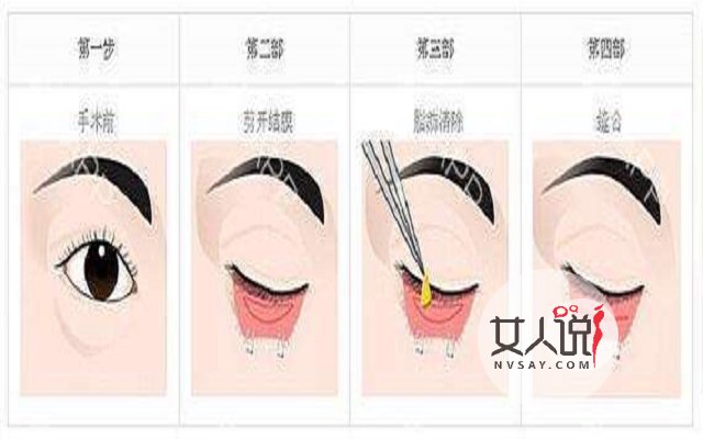 去眼袋价格不一?安全性更重要!