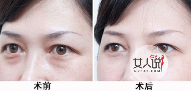 去眼袋价格不一?安全性更重要!