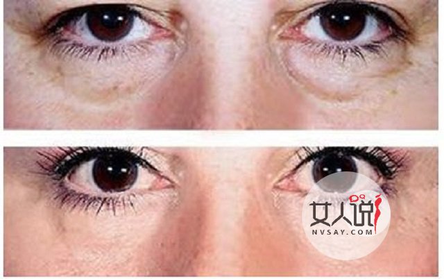 去眼袋价格不一?安全性更重要!