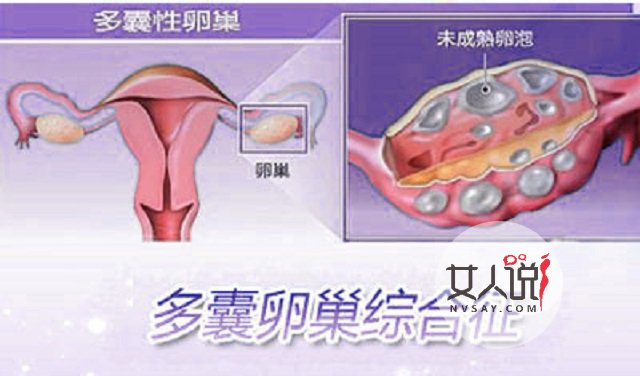 多囊卵巢综合症不是事?你摊上大事了!