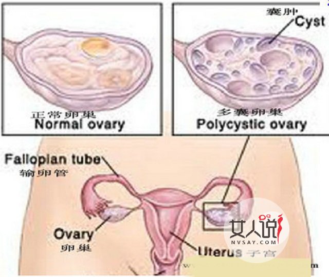多囊卵巢综合症不是事?你摊上大事了!