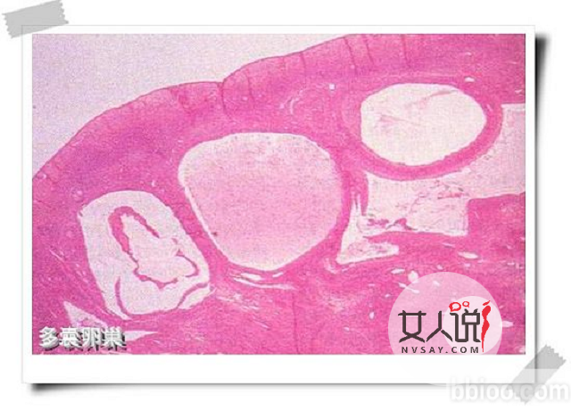 多囊卵巢综合症不是事?你摊上大事了!