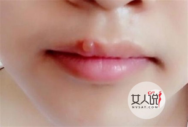 嘴角起泡什么情况?仅仅是“上火”了吗?