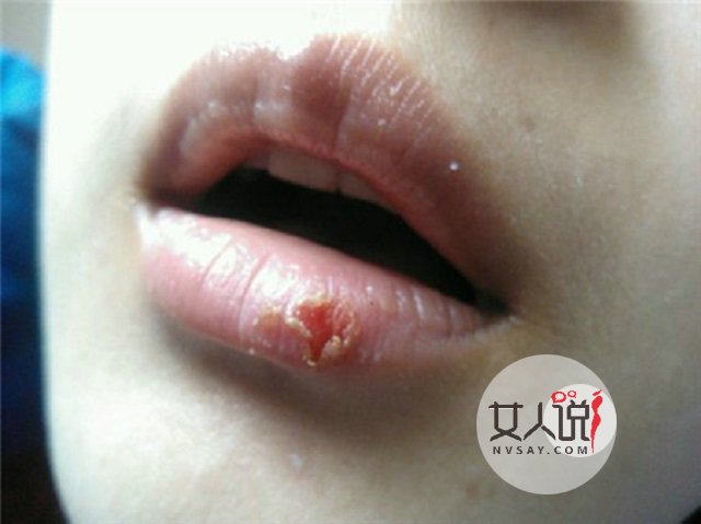 嘴角起泡什么情况?仅仅是“上火”了吗?