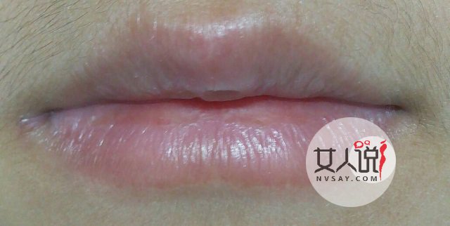 嘴角起泡什么情况?仅仅是“上火”了吗?