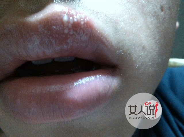 嘴角起泡什么情况?仅仅是“上火”了吗?