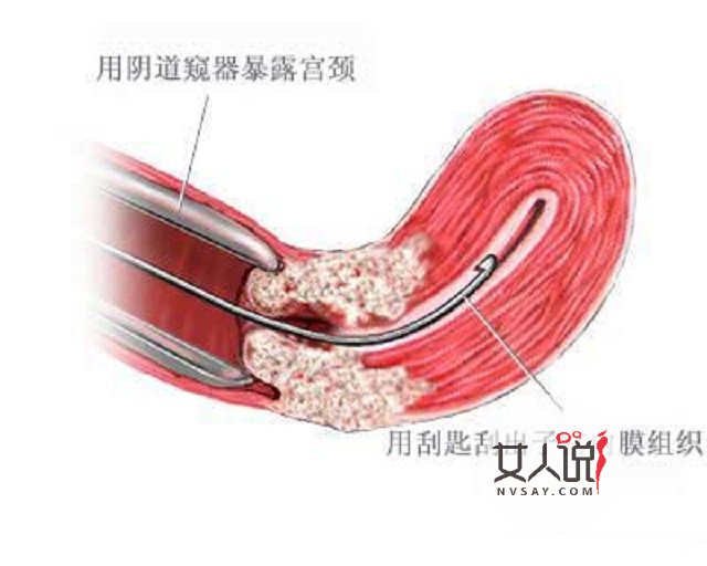 药流人流跟人工流产的区别?医学科普大讲堂开课啦!