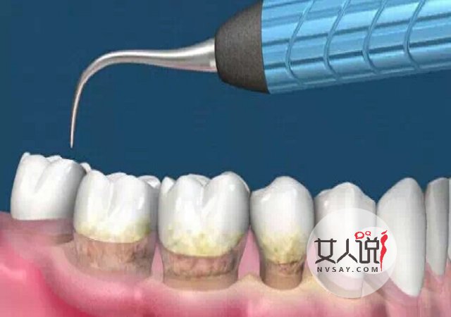 洗牙好不好别靠猜！权威专家话你知！