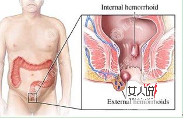 肛门出血吓一跳?“对号入座”寻病因!