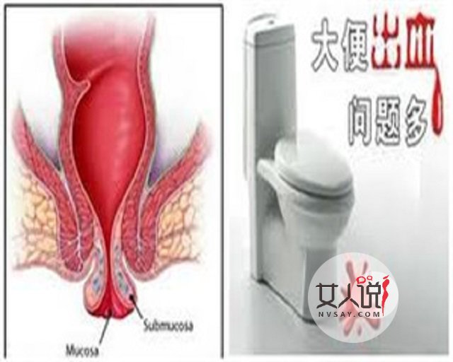 肛门出血吓一跳?“对号入座”寻病因!