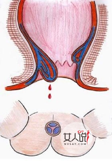 肛门出血吓一跳?“对号入座”寻病因!