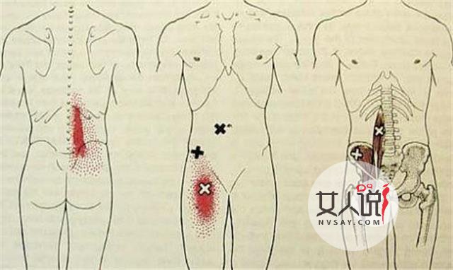 腰肌劳损别轻视,及时治疗才能够减轻痛苦!