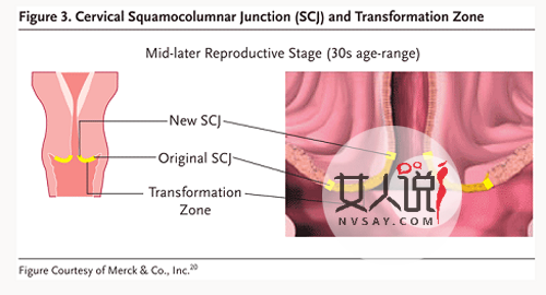 千万不要慌!治疗宫颈糜烂用什么药最好