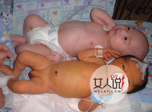 新生儿中高发的黄疸起因为何?黄疸应如何治疗