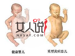 新生儿中高发的黄疸起因为何?黄疸应如何治疗