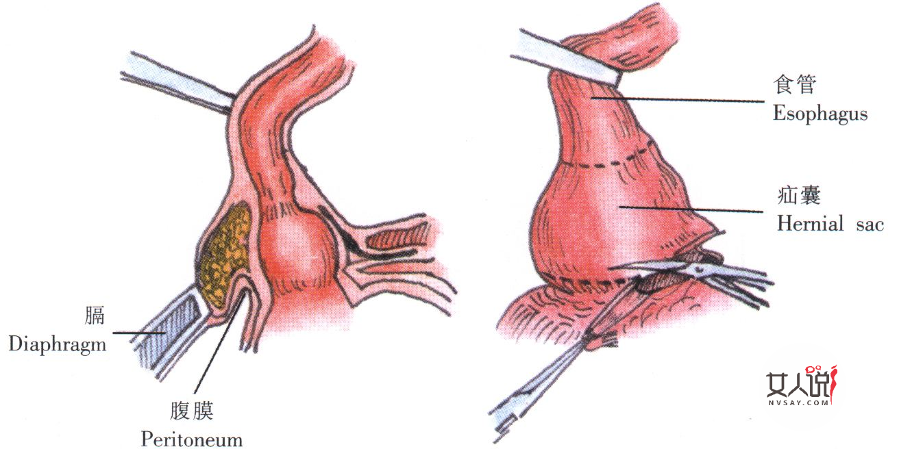 食道炎是什么?你知道食道炎的症状吗?