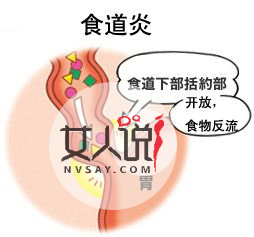 食道炎是什么?你知道食道炎的症状吗?