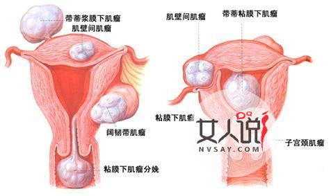 子宫肌瘤是怎么引起的,得子宫肌瘤有何症状?
