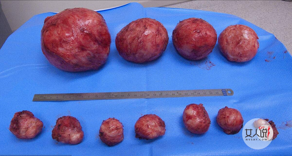 子宫肌瘤是怎么引起的，得子宫肌瘤有何症状？