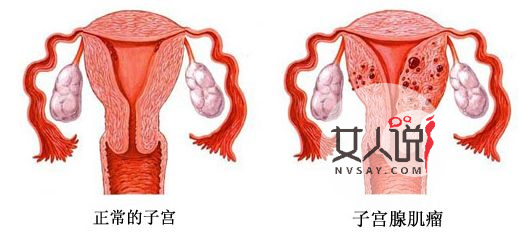 子宫肌瘤是怎么引起的，得子宫肌瘤有何症状？
