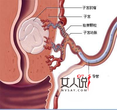 子宫肌瘤是怎么引起的，得子宫肌瘤有何症状？