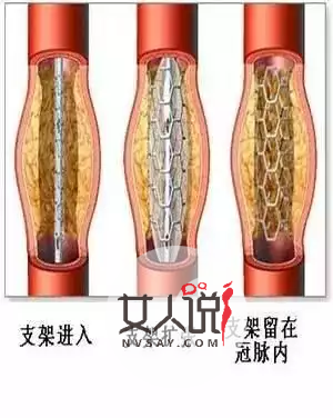知道心脏支架是什么吗？心脏支架适应症和费用