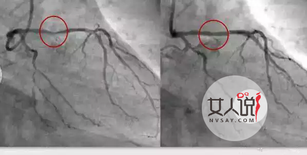 知道心脏支架是什么吗？心脏支架适应症和费用