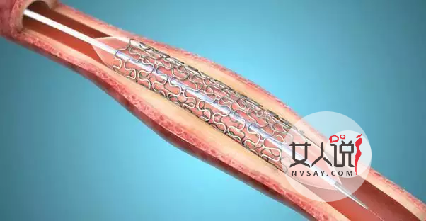 知道心脏支架是什么吗?心脏支架适应症和费用