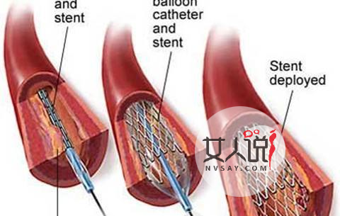 知道心脏支架是什么吗?心脏支架适应症和费用