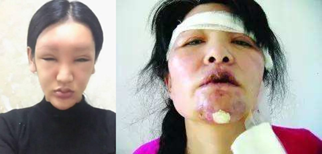 娇玛仕玻尿酸毁容案例 玻尿酸毁容事件图片曝光整容需谨慎