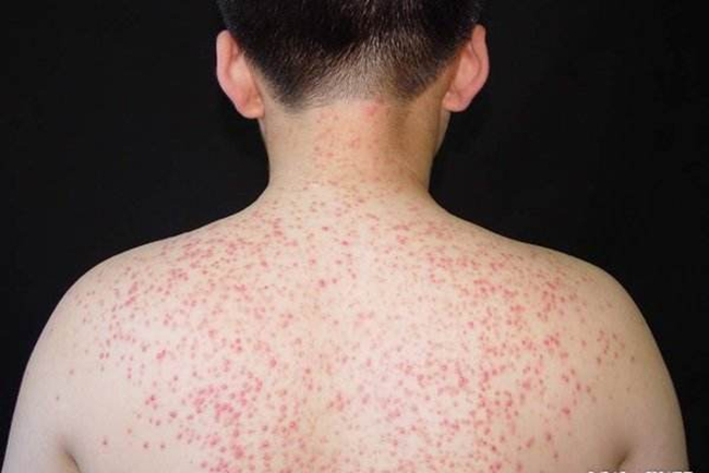 毛囊炎最佳治疗方法 看看毛囊炎图片到底怎么治疗最好