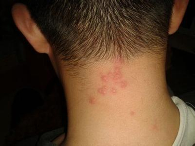 毛囊炎是怎么引起的 毛囊炎的病理原因及症状分析不得不知