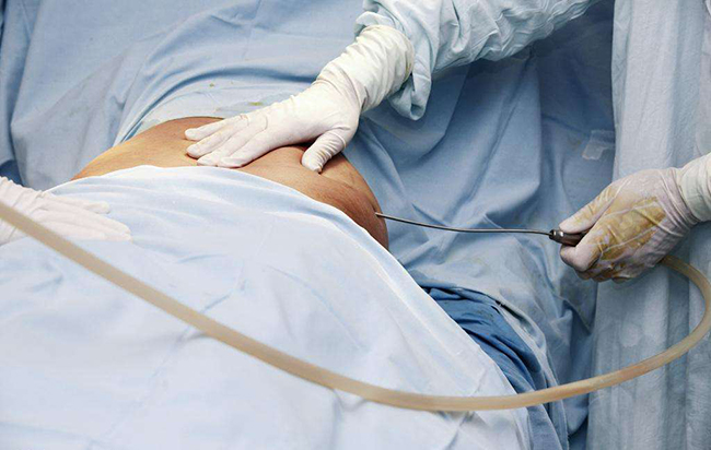 抽脂减肥过程疼吗 过程疼还是抽脂后疼进来详看