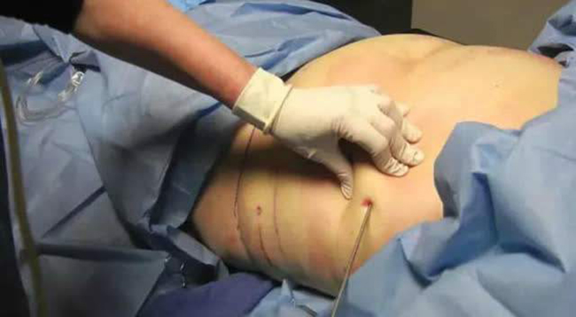 抽脂减肥过程疼吗 过程疼还是抽脂后疼进来详看