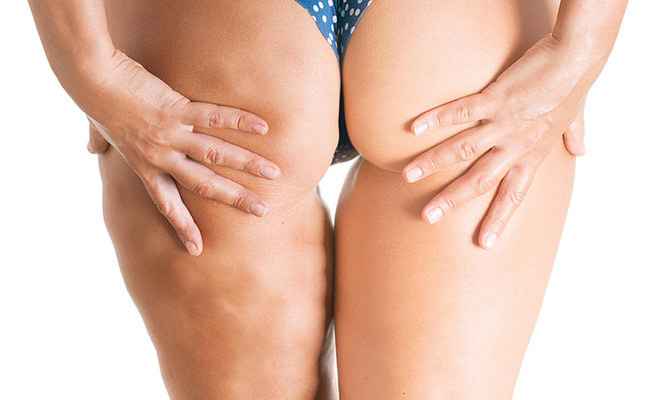 如何去除橘皮组织 4招消灭难看橘皮纹