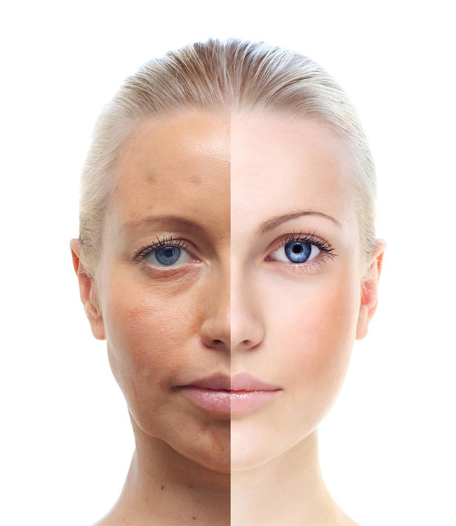 宫寒脸上会长黄褐斑吗 暖宫5步告别满脸斑点黄脸婆