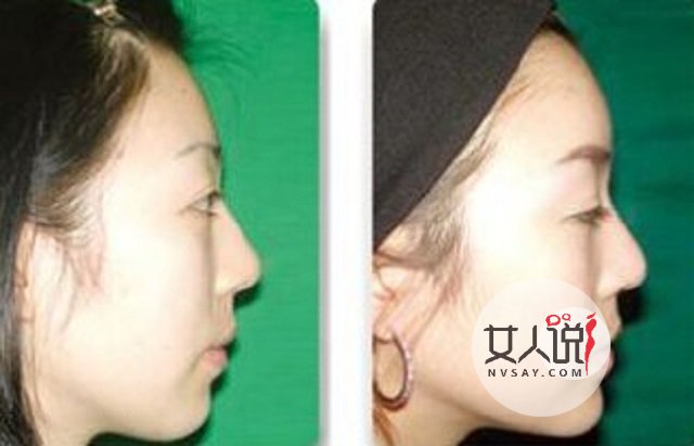 额头填充那些帮你变的更美丽的小秘密,你知道吗?